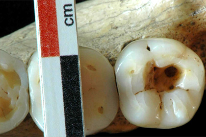 Археологи рассказали о борьбе первобытных стоматологов с кариесом