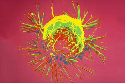Заботу о раковых клетках назвали лучшим средством лечения опухолей