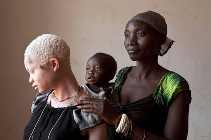 Полицейским в Малави разрешили стрелять по похитителям альбиносов