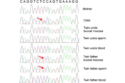 Генетики научились различать однояйцевых близнецов